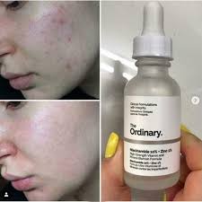The Ordinary Niacinamide 10% +Zinc 1%